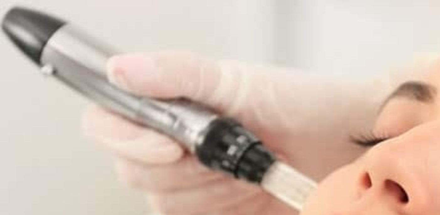 Microneedling